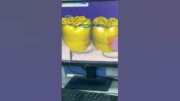 Digital denture design #dental #dentistry #digital #exocad #denture #smiledesigndental