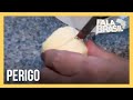 ‘Lesão do pão de queijo’: cortar o alimento congelado pode gerar ferimentos permanentes