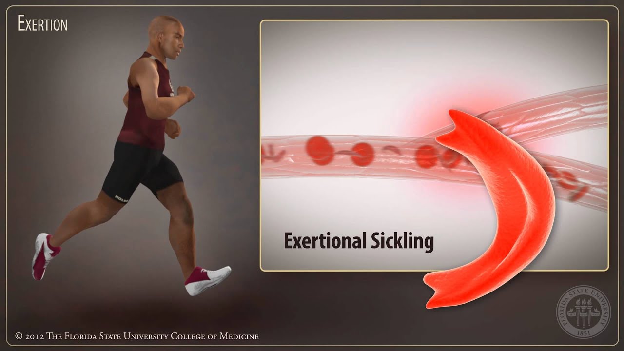 Sickle Cell Trait- Exertional Sickling in Athletes