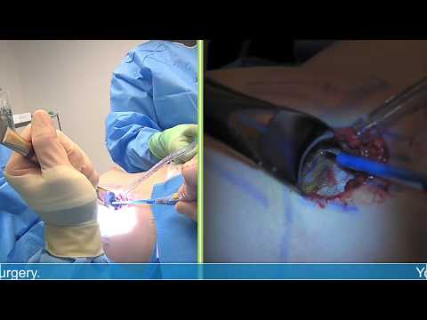 tuberous-breast-correction-surgery:-michael-j.-brown,-md-live-stream