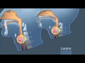 GlideScope Pediatric Airway Rounds: Small Anatomies