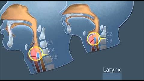 GlideScope Pediatric Airway Rounds: Small Anatomies