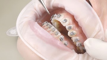 Cận cảnh gắn MẮC CÀI TỰ ĐỘNG trong NIỀNG RĂNG