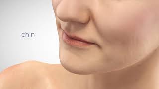 Restylane - Nasha & Obt Technologies