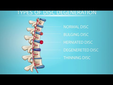 Types of Disc Herniation