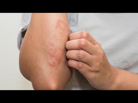Video: 3 mënyra për të zvogëluar plagët nga ekzema