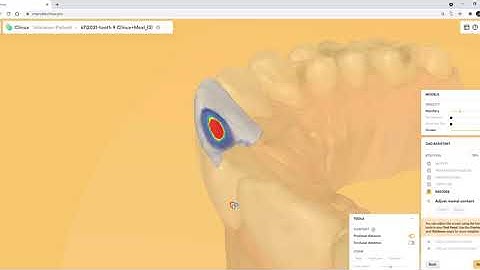 Medit scan, Clinux Design, CEREC MCXL Milling  - Easy solution from CAD-Ray
