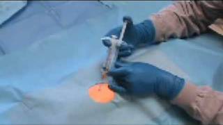 One-Handed Grip And Ultrasound With The Rpd