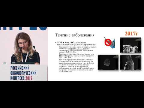 Комбинированное лечение пациента с местно-распространенной саркомой мягких тканей спины