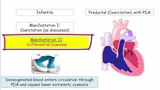 12DaysinMarch, Aortic Disorders (Part II) - Coarctation and Aortitis for USMLE Step One