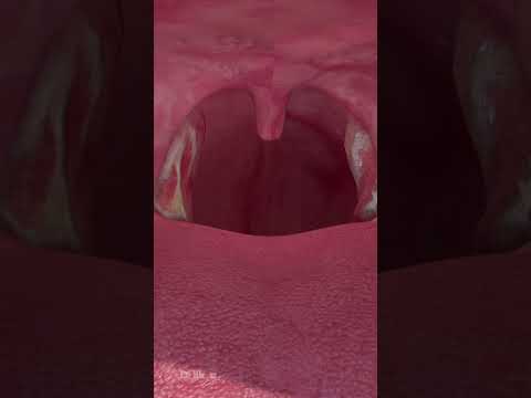 Why You Should Never Have Your Tonsils Removed