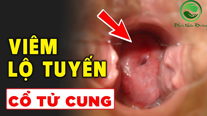 Cổ tử cung lộ tuyến tái tạo là gì