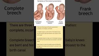 types of breech presentation# Frank breech #Complete breech # incomplete breech# baby growth in womb