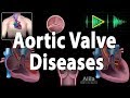 Aortic Valve Disease, Animation