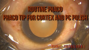 Routine Phaco-tip used for cortex and PC polish as well