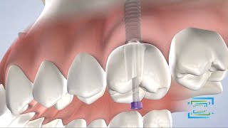 Dental Implants at Fresno Oral Maxillofacial Surgery & Dental Implant Center