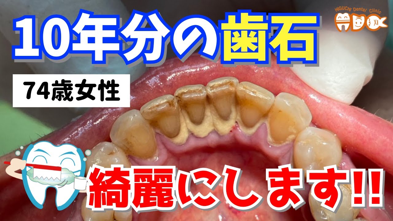 【歯石取り】10年分の歯石、綺麗にします!!【ヒグチデンタルクリニック】 - YouTube