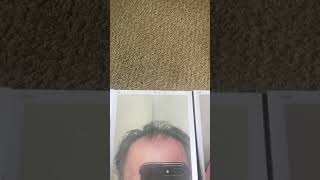 The fastest way to regrow hair mpb
