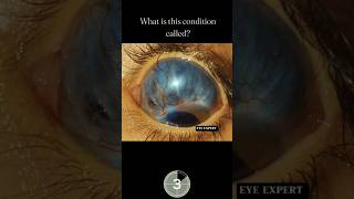Eye Disease Knowledge 🙀#eyes #eyecareprofessional #optometrist #eyespecialist #eyediseases