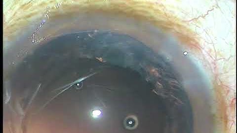 In-the-bag IOL implantation in presence of P C Rent, PM, March 13, 2018