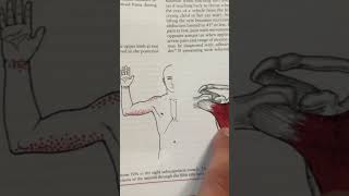 Trigger Point Pain From The Subscapularis