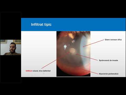 Webinar Keratite infecțioase