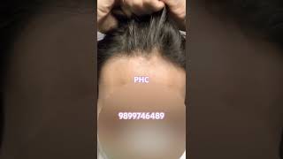 Ultra Thin Undetectable Hair Patches For Men From Phc Wigs Delhi