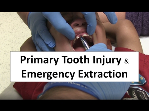 वीडियो: शिशुओं में दांत कैसे निकलते हैं