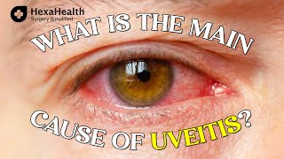 Know more about uveitis - an eye disorder|| Uveitis Surgery || HexaHealth expert Dr. Rashi Jain