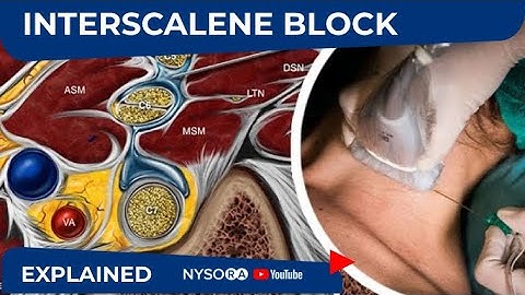 NYSORA Regional Anesthesia Interscalene Block