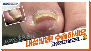 내성발톱 수술을 종결하게 만든 바로 그관리!!