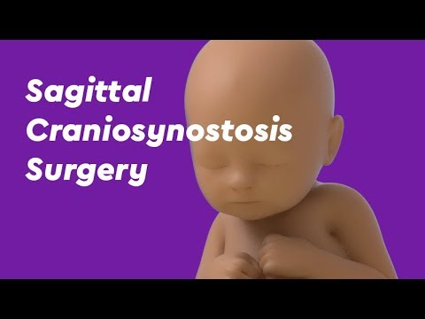 Video: Craniostenosis - Behandeling, Craniostenosis Bij Pasgeborenen