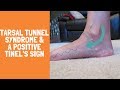 Tarsal Tunnel Syndrome with a Positive Tinel's Sign