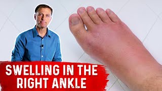 What Causes Right Ankle Edema?