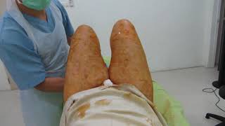 Inner Thighs Liposuction MVI 9428 Inner Thighs Liposuction MVI 9428