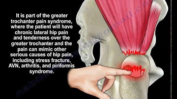 Gluteus Medius Tendon Tear  - Everything You Need To Know - Dr. Nabil Ebraheim