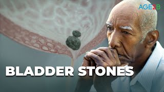 What Are Bladder Stones? Causes, Symptoms & Remedies screenshot 5