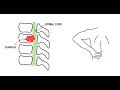 Spinal Cord Compression