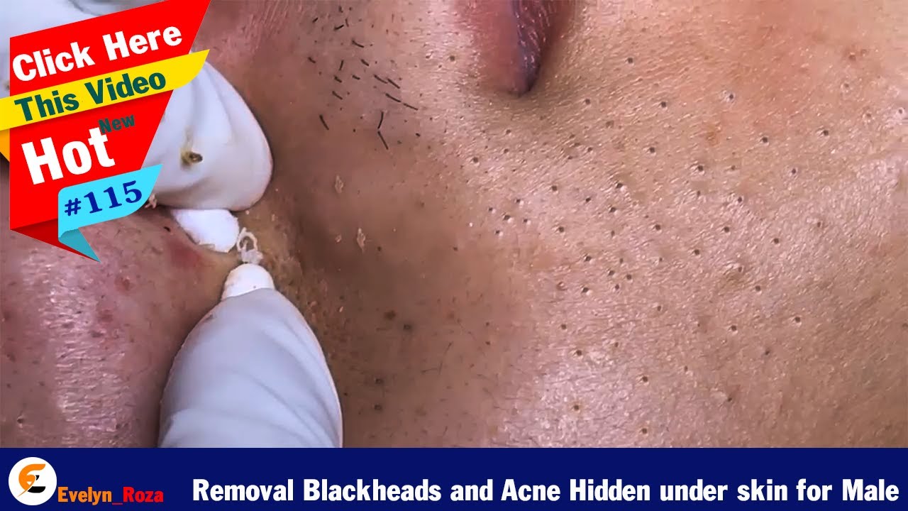 Removal Blackheads and Acne Hidden under skin for male |  Acne Treatment 115