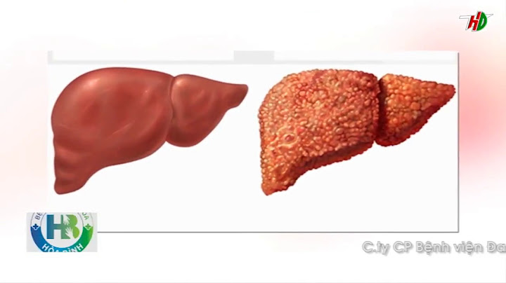 Nhu mô gan không đều là như thế nào năm 2024