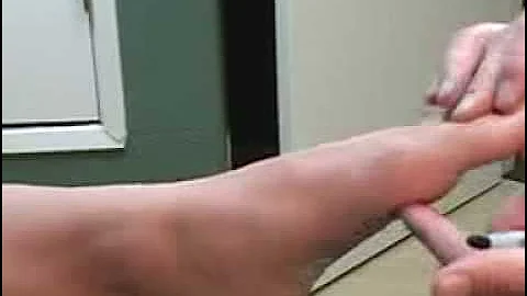 Bunion: Postoperative Range of Motion