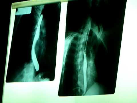 radiografia de doble contraste radiografia de doble contraste