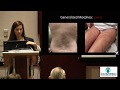 Localized scleroderma morphea lisa pappastaffer md  2018 patient education conference