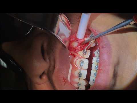 Impacted decayed Tooth extraction - Dr. Ben Fong