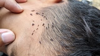 How remove million head lice from brown hair - How to get rid a lot of big lice