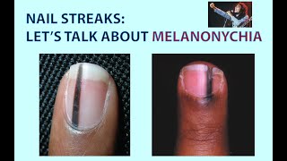 Streaks in Your Nails? Let's Talk about Melanonychia. We'll Also Look at  Skin Tags & Skin Polyps - YouTube