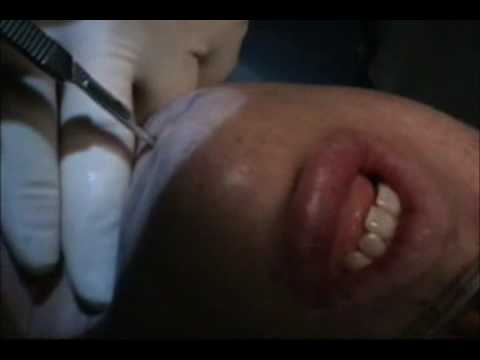 Chin Implant Plastic Surgery By Dr Michael Yaremchuk Youtube