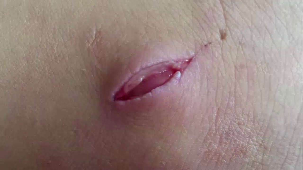 Fases de cicatrización en un herida | Fases de reparación tisular - YouTube