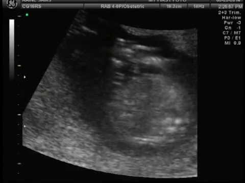 Kleven Baby Gender Determination 16 weeks(Boy or girl ...