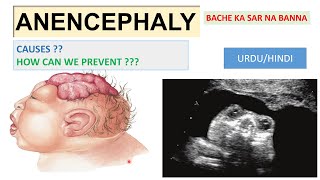 ANENCEPAHLY | BACHE KA SAR ULTRASOUND PER NA NAZAR ANA ? CAUSES |PREVENTION | TREATMENT screenshot 3